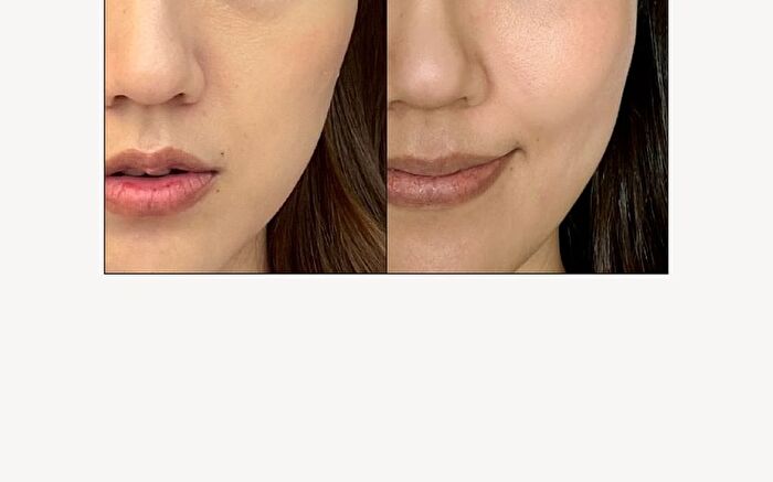 Firming Microdart Eye Patch with Bakuchiol, Niacinamide & Peptides - 1 Box (4 pairs)