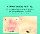 Hiffect Madeca Tea Tree Ampoule - 50ml